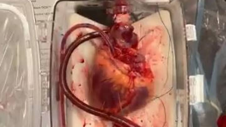 Doctors Complete First Heart Transplant From Dead Donor In Breakthrough Surgery 
