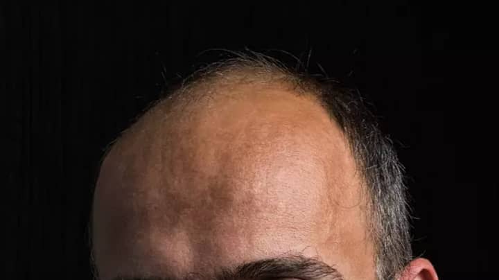 Bald Men Could Be At Greater Risk Of More Serious Covid Symptoms