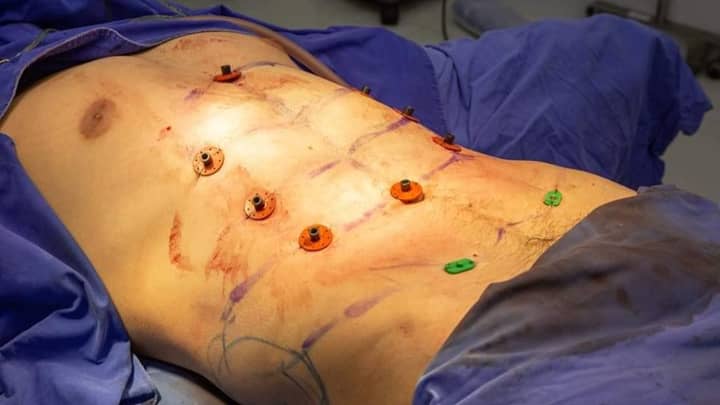 Instant Six Pack Surgery Is Now A Thing