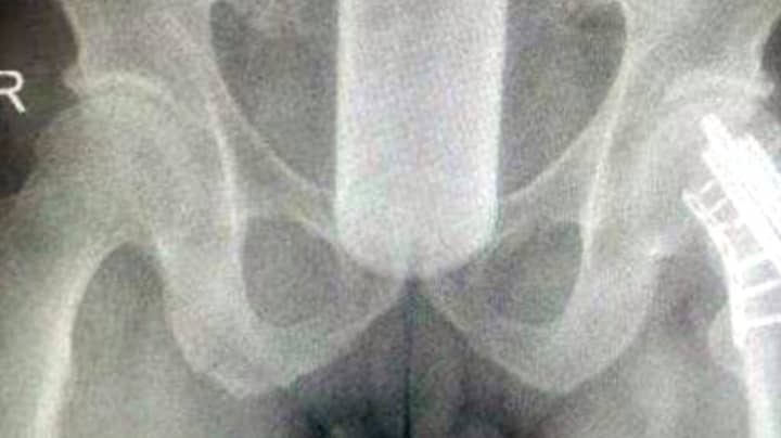 Man Loses 7-Inch Bottle Up Bum After Using It To 'Scratch An Itch'