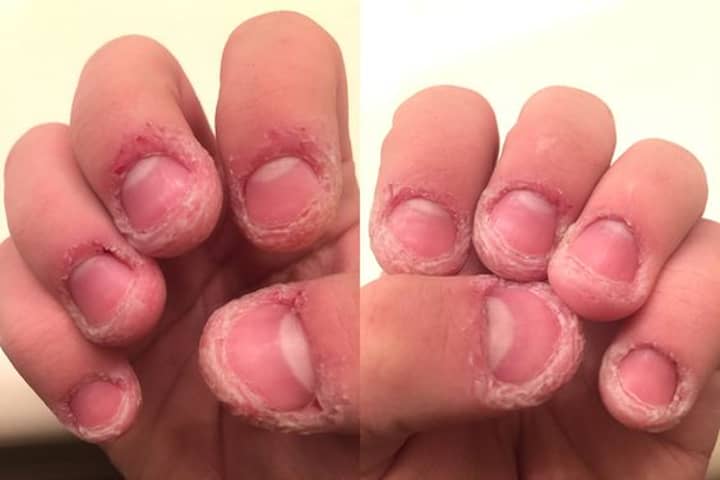 Why You Shouldn't Bite Or Pick The Skin Around Your Finger Nails - LADbible