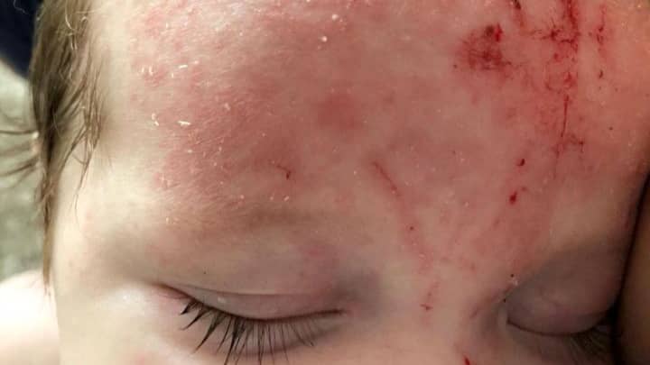 Mum Praises £6.95 Cream For Curing Baby Son’s Painful Eczema 