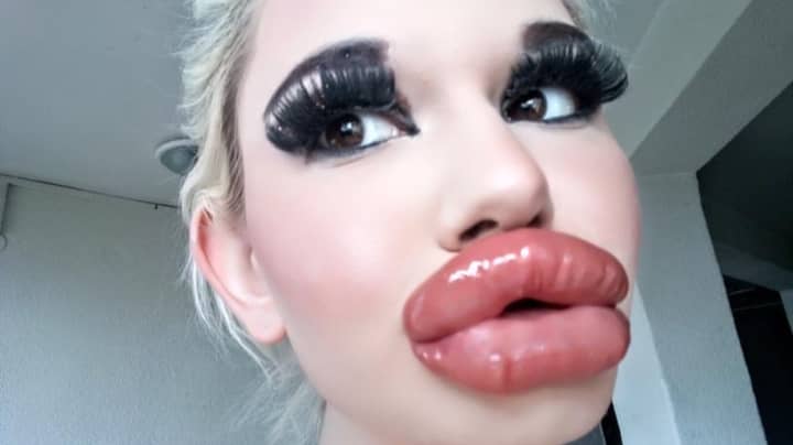 Woman Shares Photos Of Her Mouth After 20th Acid Lip Injections