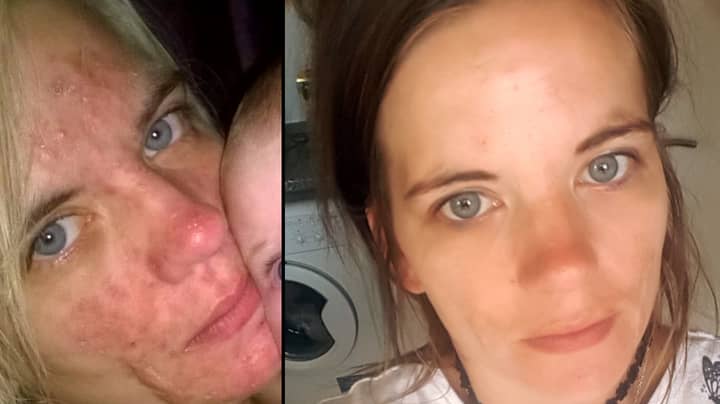 Woman Says £3 'Miracle Cream' Completely Cleared Up Her Acne 