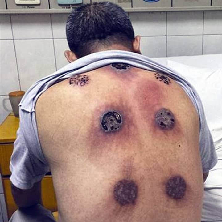 Chinese Man Left With Huge Holes In His Back After Cupping Therapy