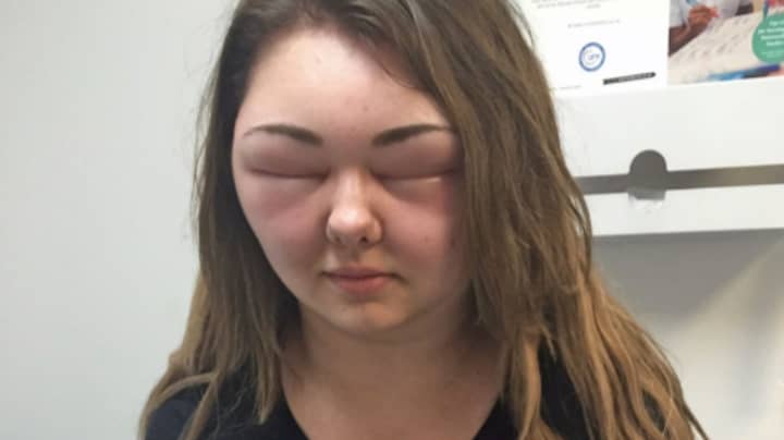 Woman's Face Swells Three Times Usual Size After Allergic Reaction To Hair Dye 