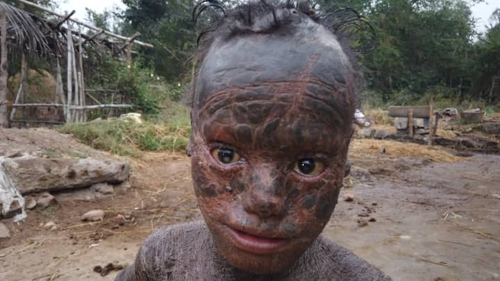 Ten-Year-Old Boy With Rare Condition Sheds His Skin Every Month 