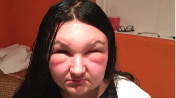 Teenager Uses Coffee To Colour Her Hair After Dye Gives Her Allergic  Reaction - LADbible
