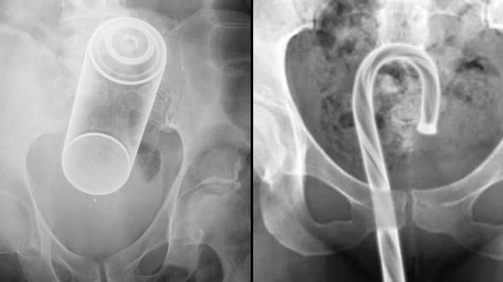 Bizarre Objects Stuck In People's Orifices That Required Visits To ER Revealed