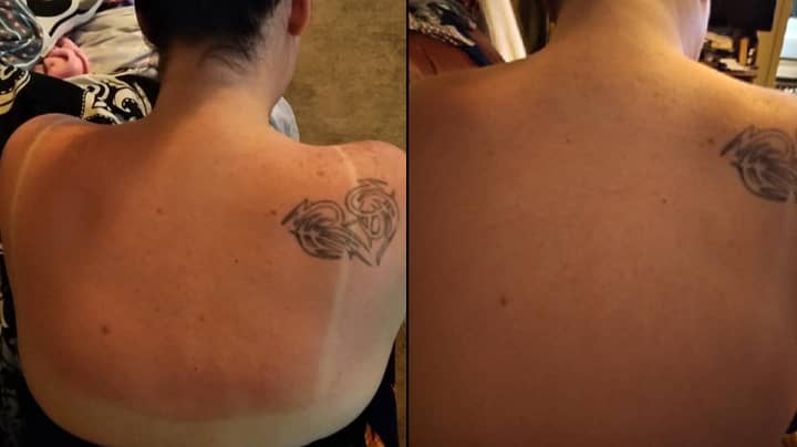 Woman Reveals Amazing 30 Minute 'Miracle' Cure For Sunburn