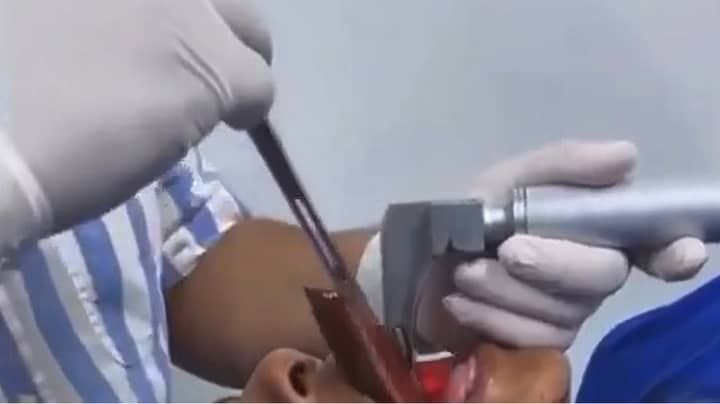 Doctors In Colombia Remove 18cm Fish From Man's Throat