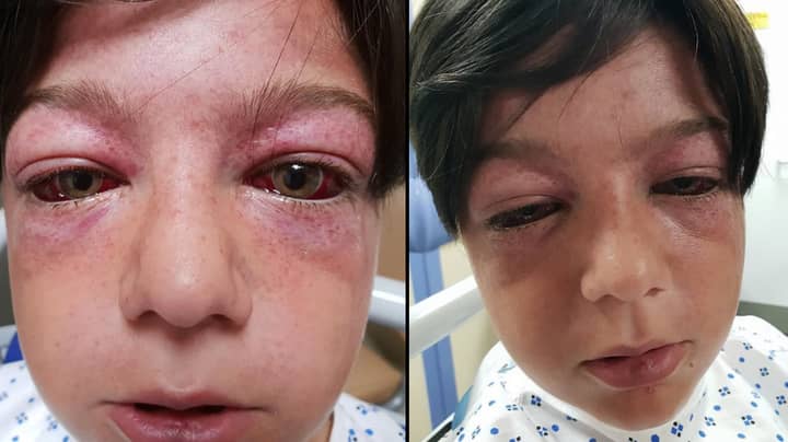 Horrific New Playground 'Stunt' Left Boy, 11, Looking Like An 'Alien'