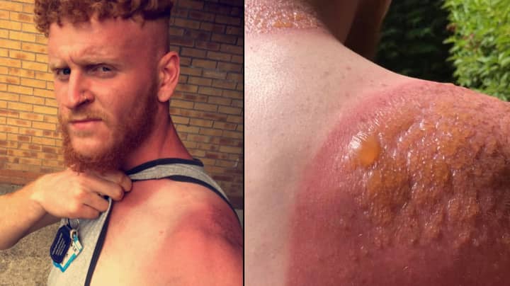 Scottish Bloke Gets Outrageous Second Degree Burns From Working In Sun