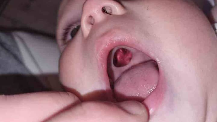 Mum Embarrassed After Rushing Baby To Hospital With 'Hole' In Mouth Only To Find It Was A Sticker