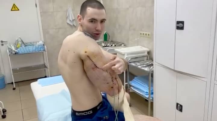 'Russian Popeye' Undergoes Surgery To Remove Hardened Jelly From Fake Muscles 