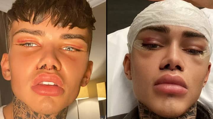 Man Spends £30,000 On Surgery To Look Like An Instagram Filter