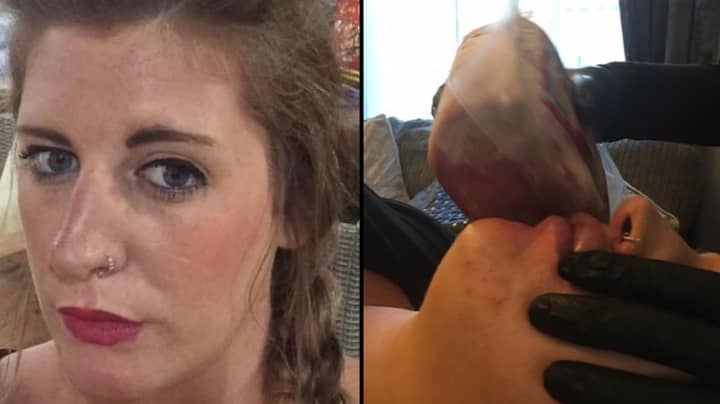 Mum Scared To Leave House After Lip Filler Leaves Her With 'Duck Lips'