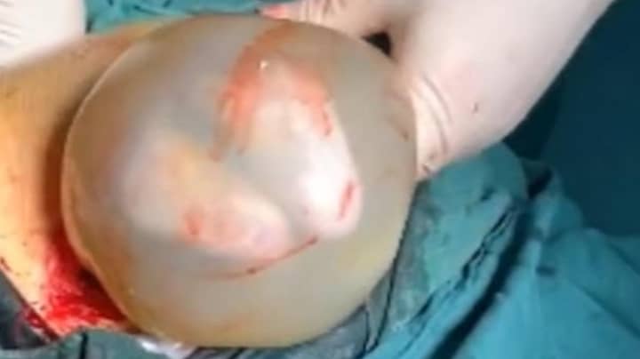 Baby Born Inside Amniotic Sac After Emergency C-Section 