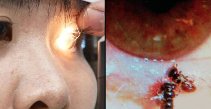 Bees Live In Woman's Eye Socket Feasting On Her Sweat And Tears