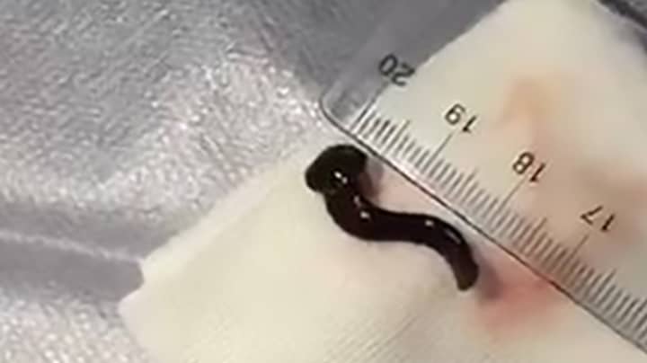 Doctors Remove 3cm-Long Live Leech From Woman's Throat 