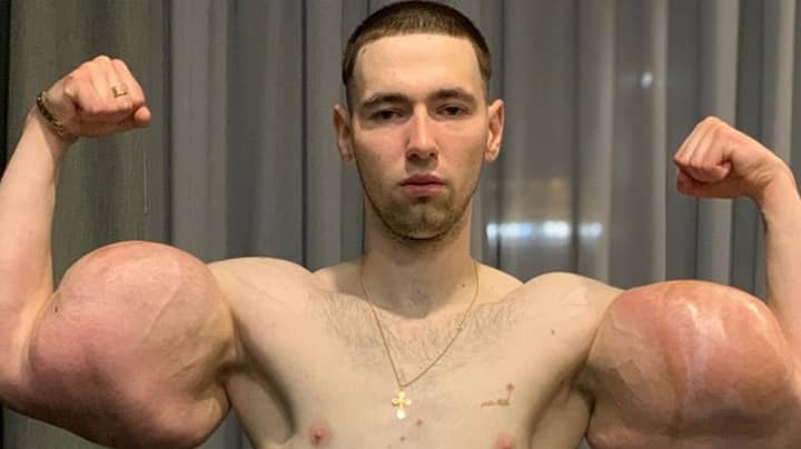 Doctors Cut Huge Lumps Of 'Jelly' Out Of Russian Popeye's Arms