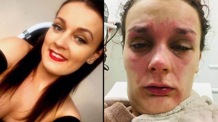 Teenager Left Blinded When Egg Explodes In Face After Cooking It In Microwave