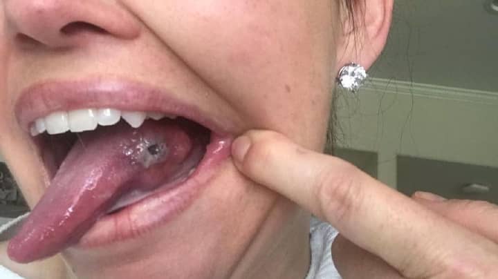Mum Thought She Had Bitten Tongue In Her Sleep But Actually Had Cancer