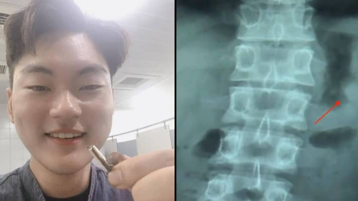 Man Poos Out AirPod He Accidentally Swallowed And It Still Works