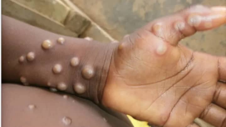 More Than 200 People In US Being Monitored After Possible Exposure To Monkeypox 
