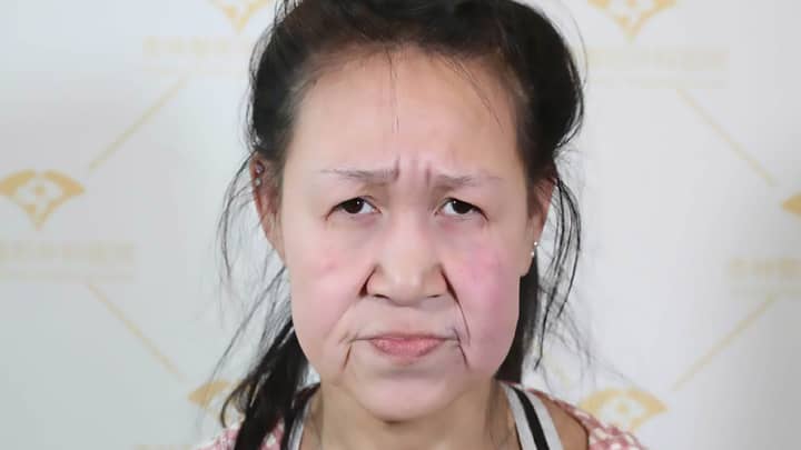 Teenager Who Looked Like A 'Grandmother' Given 'New Face'