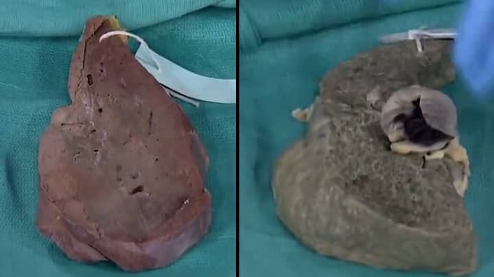 Doctor Shows What Years Of Chronic Drinking Does To Your Liver 