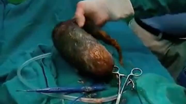 Doctors Remove 15lb Hairball From Teenager's Abdomen