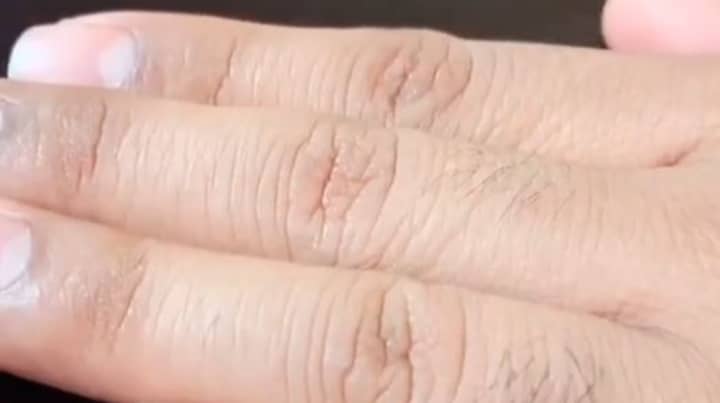 Simple Skin Pinch Test Will Tell If You're Dehydrated