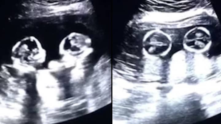 Identical Twins Spotted 'Fighting' Inside The Womb During Ultrasound