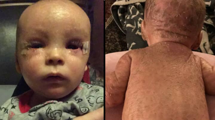 Cannabis Oil Cures Toddler Who 'Looks Like A Fish' Due To Skin Condition