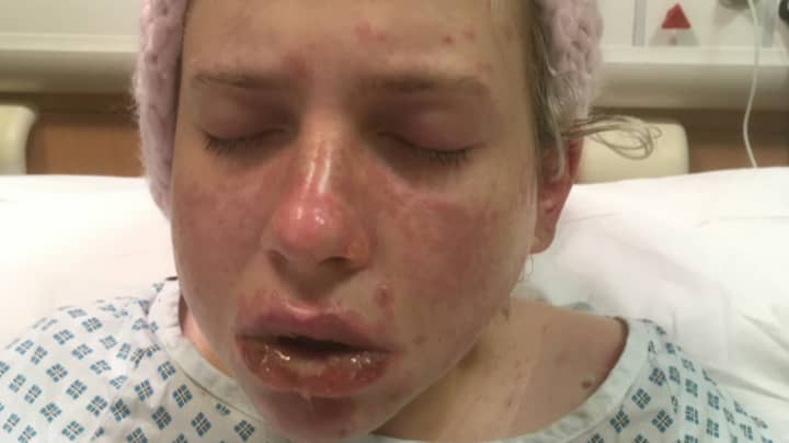Woman Lucky To Be Alive After Body 'Burns Itself From Inside Out' Due To Rare Condition