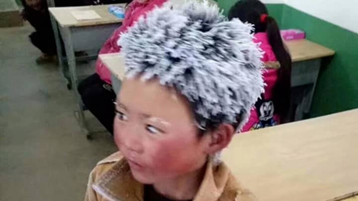 Chinese Boy With Frozen Hair Has Received A Fraction Of Donation Money 