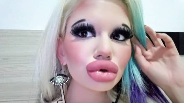 Woman Triples Size Of Her Lips With 15 Surgical Procedures 