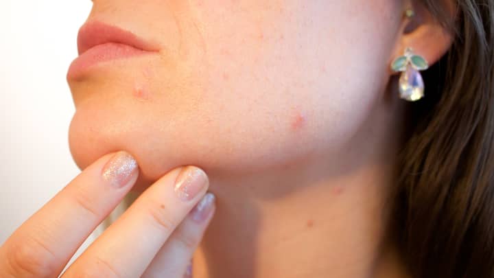 Scientists Say A Cure For Acne Could Be On The Horizon