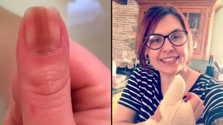 Woman, 36, Who Hid 'Embarrassing' Line On Fingernail Told It's Rare Cancer