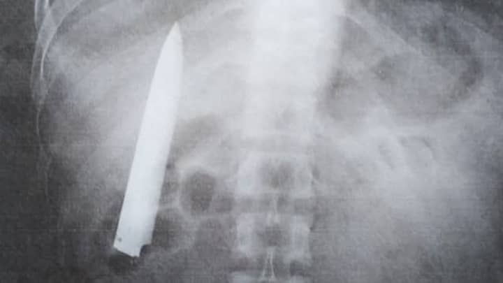 Man Had No Idea Knife Was Lodged In His Chest A Year After Being Stabbed