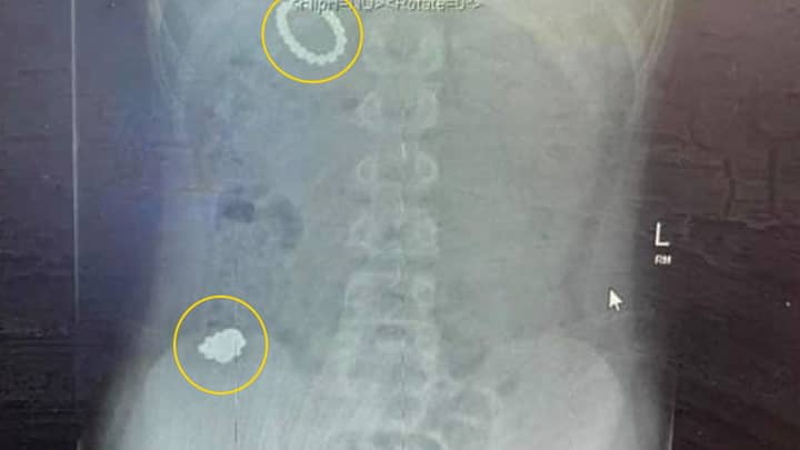 Boy Undergoes Operation After Swallowing 54 Magnets 'To See If He'd Become Magnetic'