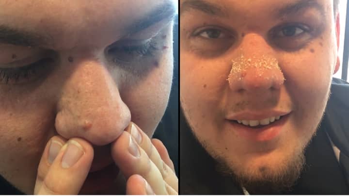 ​This Man’s Blackhead Removal Technique Is A Complete And Utter Gamechanger  