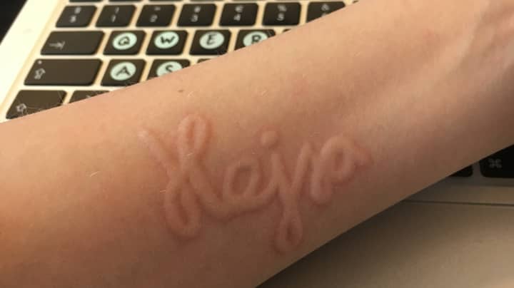 Teenager Has Rare Condition That Turns Her Skin Into 'Human Etch A Sketch'