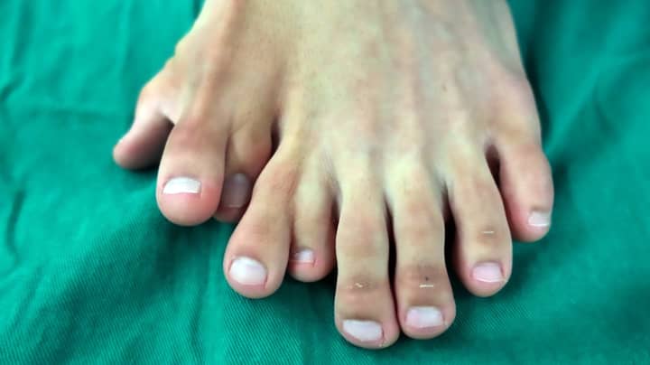 Man Born With Nine Toes On One Foot Has Surgery To Remove Extra Digits