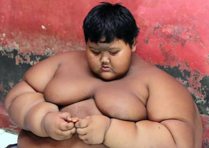 'World’s Fattest Child' Put On Crash Diet To Save His Life 
