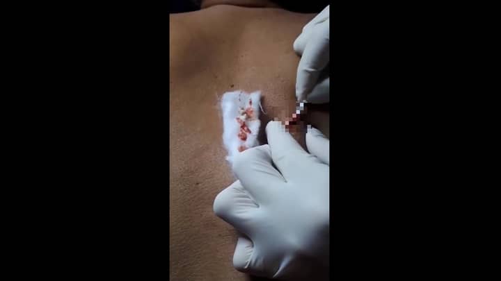 10-Year-Old Pimple Removed From Man's Back